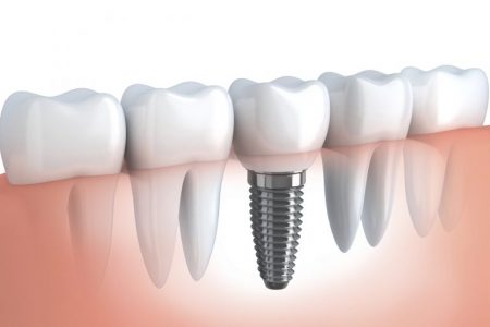 The Benefits of Dental Implants
