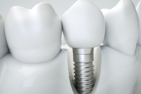 Seven Advantages of Dental Implant Surgery